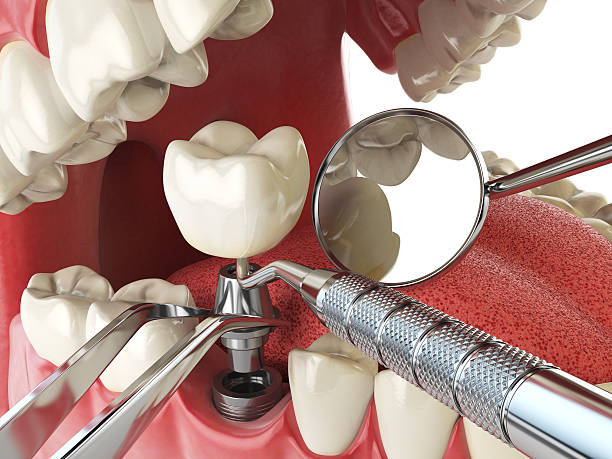 Best Emergency Root Canal Treatment in Chauvin, LA